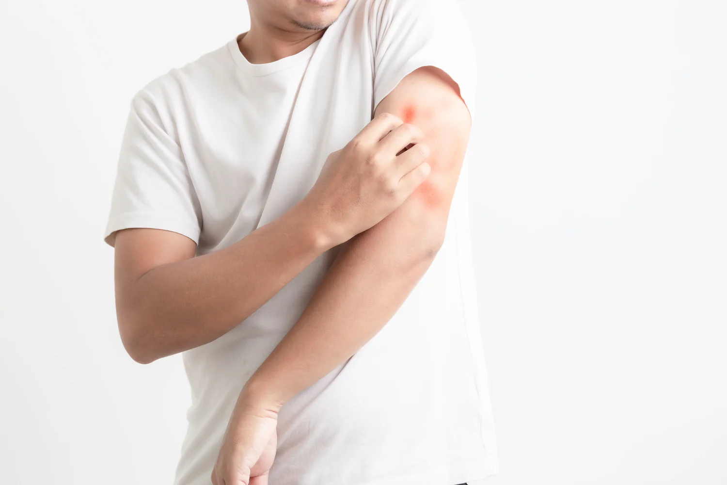 5 Tips Merawat Kulit yang Sering Terkena Alergi